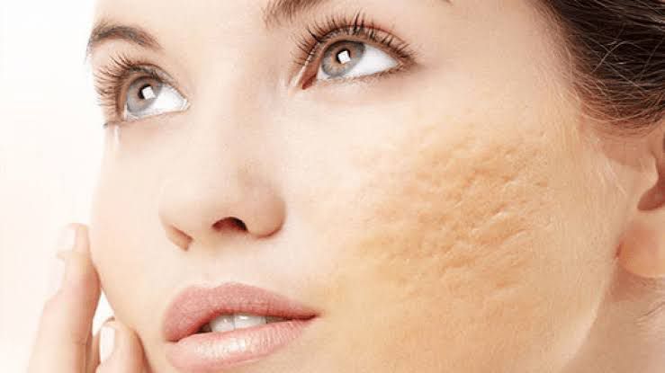 Radiesse en Ageless Med Clinic - Rejuvenece y Reafirma Tu Piel